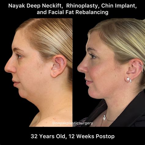 Before & After Deep Necklift Procedures in St. Louis MO | Nayak