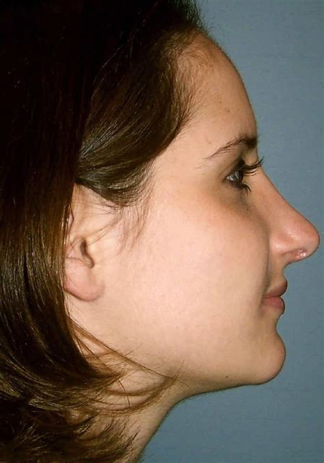 Rhinoplasty | Cosmetic Nose Surgery - Cleveland Cosmetic Surgery