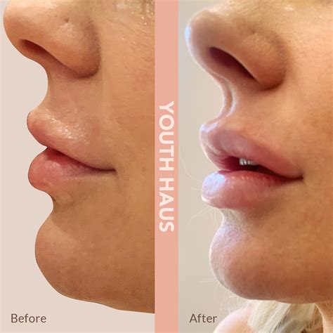 Collagen In Lips Before And After | Lipstutorial.org