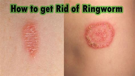 RingWorm – Sreepathy Ayurveda