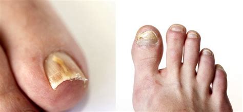 povidone iodine toenail fungus - Toenail Fungus Treatment | Toenail Fungus Treatment