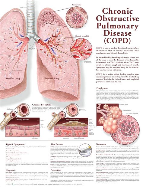 Chronic Obstructive Pulmonary Disease: What You Should Know Infographic