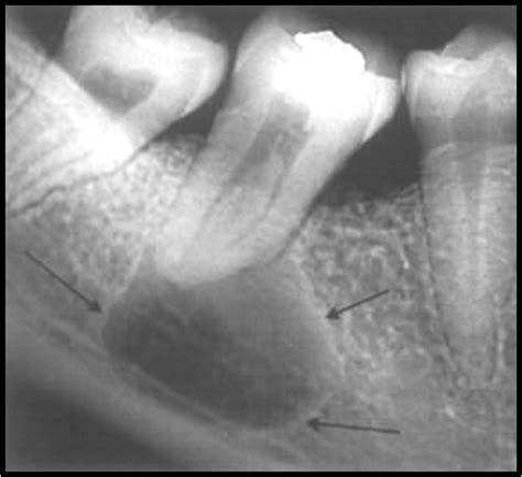 Radicular Cyst Radiology