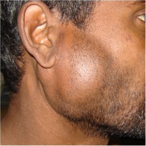 The right parotid swelling with level-II, level-V lymph | Open-i