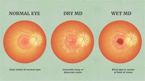 Macular Degeneration (AMD) - Articles on Wet and Dry