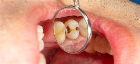 Five Stages of Tooth Decay | Mint Hill Dentistry