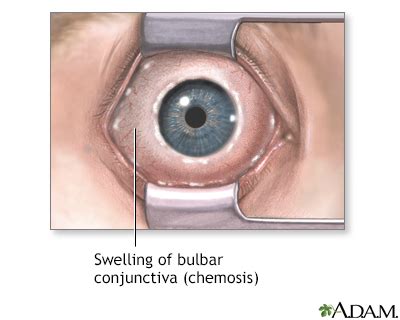 HIE Multimedia - Chemosis