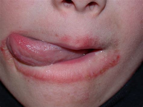 Lip Licker's Dermatitis-A Common Problem During Winter