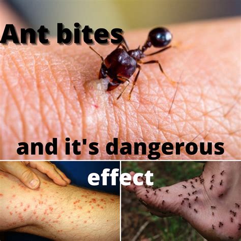 What should we do when an ant bites?