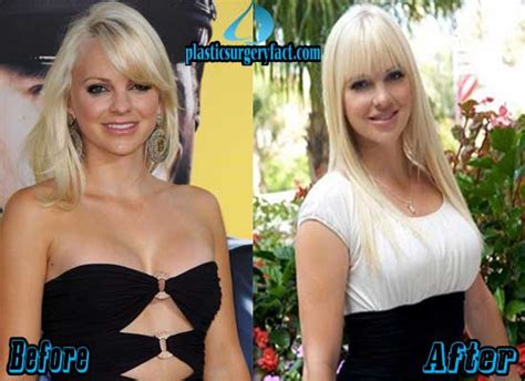 Anna Faris Plastic Surgery Before and After Photos