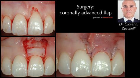 Mucogingival Esthetic Surgery | Zerodonto