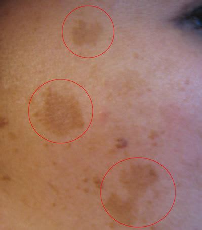 Мелазма - Melasma - abcdef.wiki