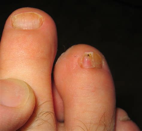 Infections Caused by Common Fungus - Clear Toes Clinic