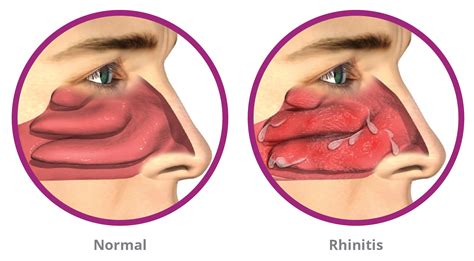 New Breakthrough in the Treatment of Chronic Rhinitis (Runny Nose ...