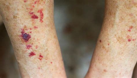 Purpura: Blood Spots, Thrombocytopenic, Symptoms & Causes