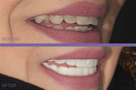 Snap-On Smile Temporary Veneer | Chicago Veneers