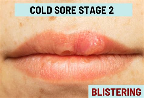 Beautiful Work Tips About How To Stop Cold Sore Swelling - Sumresort14