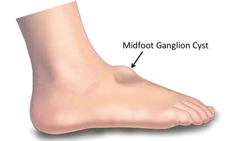 Ganglion Foot Cyst | Foot & Podiatry Surgery