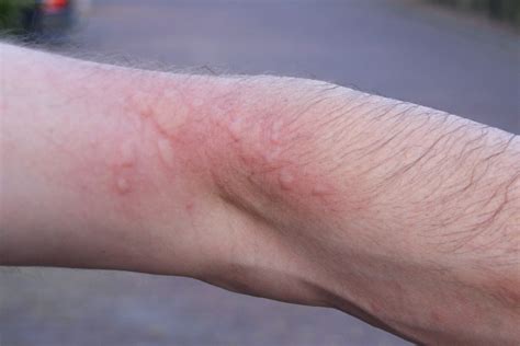 How To Avoid And Treat Brown-tail Moth Rash