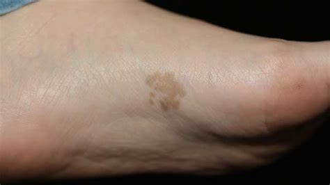 Hearing do not do Genealogy dark spots on soles of feet solid Uplifted Disparity