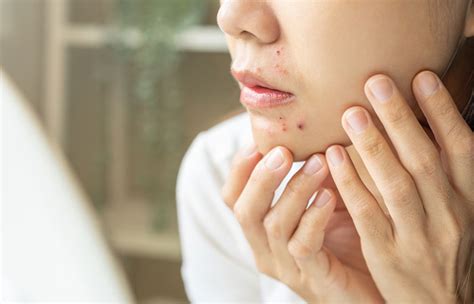 How To Get Rid Of Pimple On Lip: Remedies & Prevention