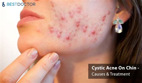 Cystic Acne On Chin / Treatment of cystic acne - Cystic Acne on Chin / Find out what causes ...