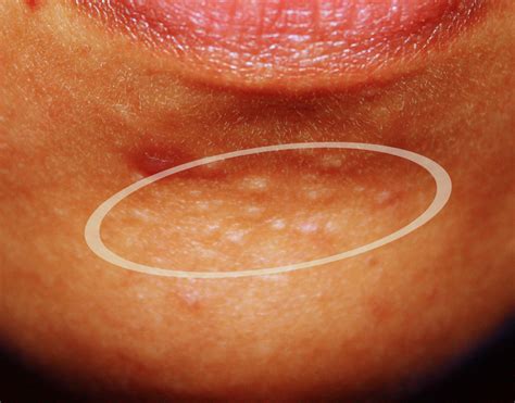 The bumps on chin. Are these acne? – General acne discussion – Acne.org Forum