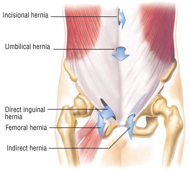 Hernia Repair - Harvard Health