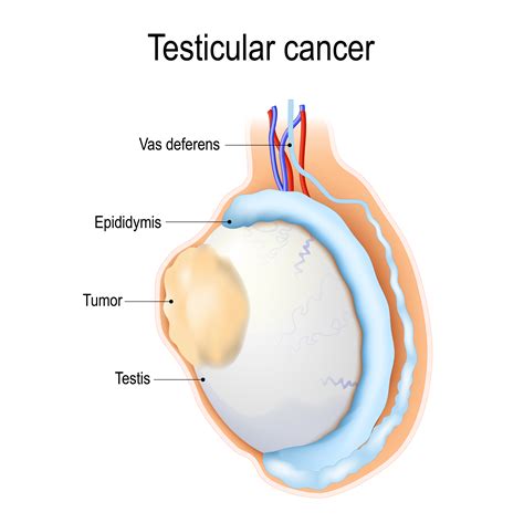 Testicular Cancer Causes | What Are The Risk Factors For Testicular Cancer