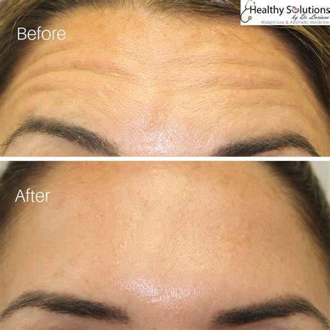 Botox: Before And After Photos Gallery | Healthy Solutions Medspa