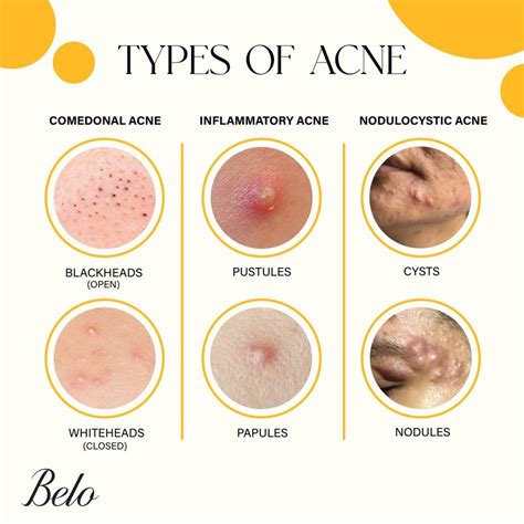 Understanding Acne: Common Types and Triggers