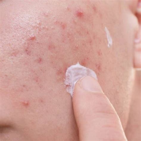 How to Reduce Acne Inflammation: A Full Guide • Mommy's Memorandum