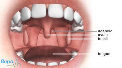 Adenoid and tonsil removal