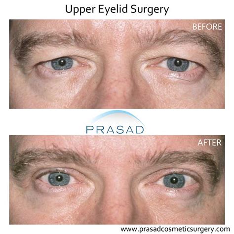 Can Plastic Surgery Fix Hooded Eyes? | Prasad Cosmetic Surgery