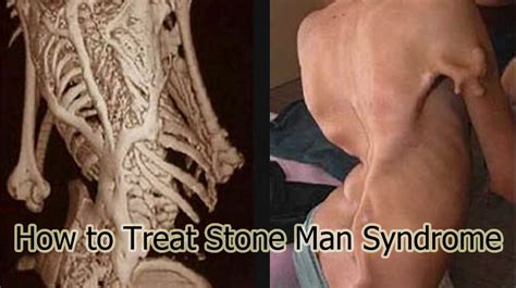 How to Treat Stone Man Syndrome