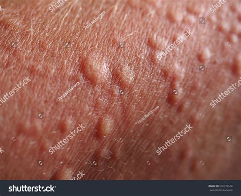 Symptoms Contact Allergy On Hands Skin Stock Photo 696677566 | Shutterstock