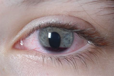 Eye injury causes, traumatic or chemical eye injury symptoms & treatment