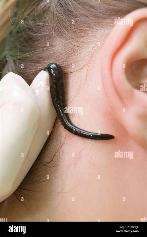 Hirudo therapy. Leech therapy. Hirudinea medicinal. Healer apply leech ...