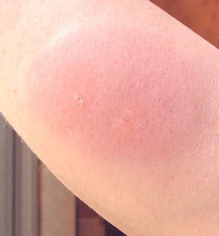 Insect Bites--When to Worry?... - Hyde Park Pediatrics