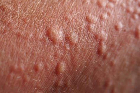 Bumps on Skin: Skin Mysteries Explained | Reader's Digest