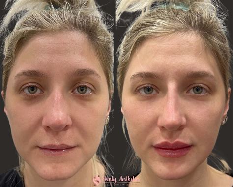 Cheek Fillers - Before & After Results at Skinly