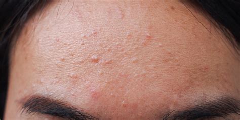 What Is Fungal Acne? Pityrosporum Folliculitis Causes And Treatment | lupon.gov.ph