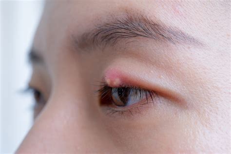 Blepharitis: Causes, Symptoms, and Treatment