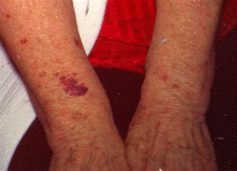 Causes of senile purpura - Information and symptoms of senile bleeding ...