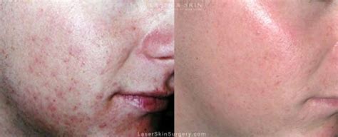 Acne & Acne Scar Treatment New York, NY | Laser Center