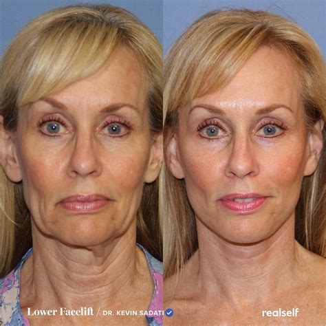 Lower Facelift vs. Neck Lift: What’s the Difference? in 2024 | Lower face lift surgery, Face ...