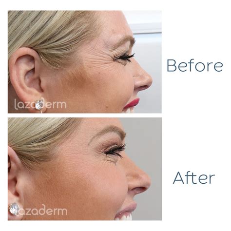 Botox Before and After Photos — Lazaderm Laser & Aesthetics