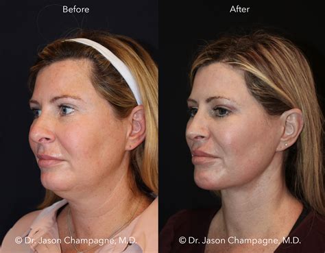 Advanced Radio Frequency Skin Tightening Gallery | Beverly Hills Plastic Surgeon - Dr. Jason ...