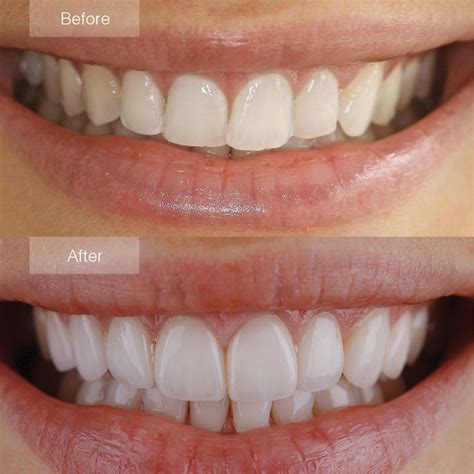 Clip On Veneers: The Perfect Smile Solution - ColorMag