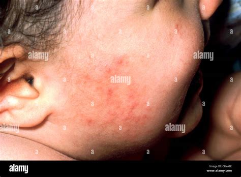 ECZEMA ATÓPICO Fotografía de stock - Alamy